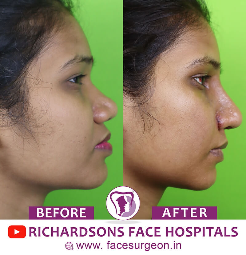 http://Rhinoplasty%20Girl%20Side%20View%20Before%20After