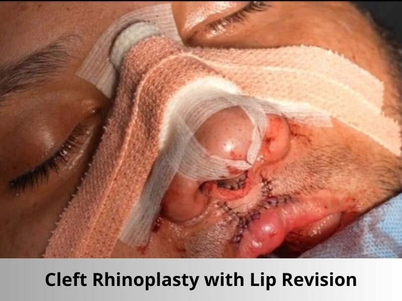 cleft rhinoplasty lip revision