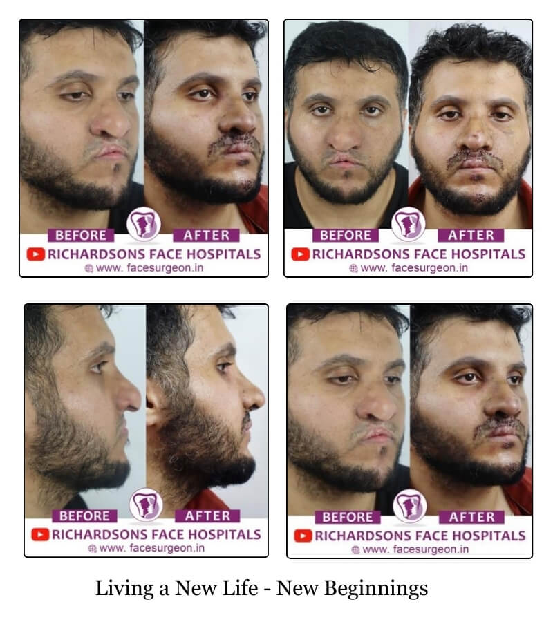 facial transformative surgeries