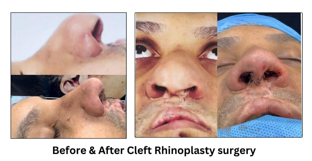 rhinoplasty surgery cleft