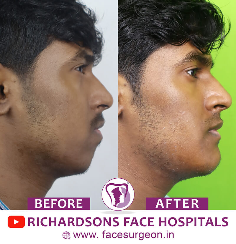 http://Genioplasty%20Before%20After