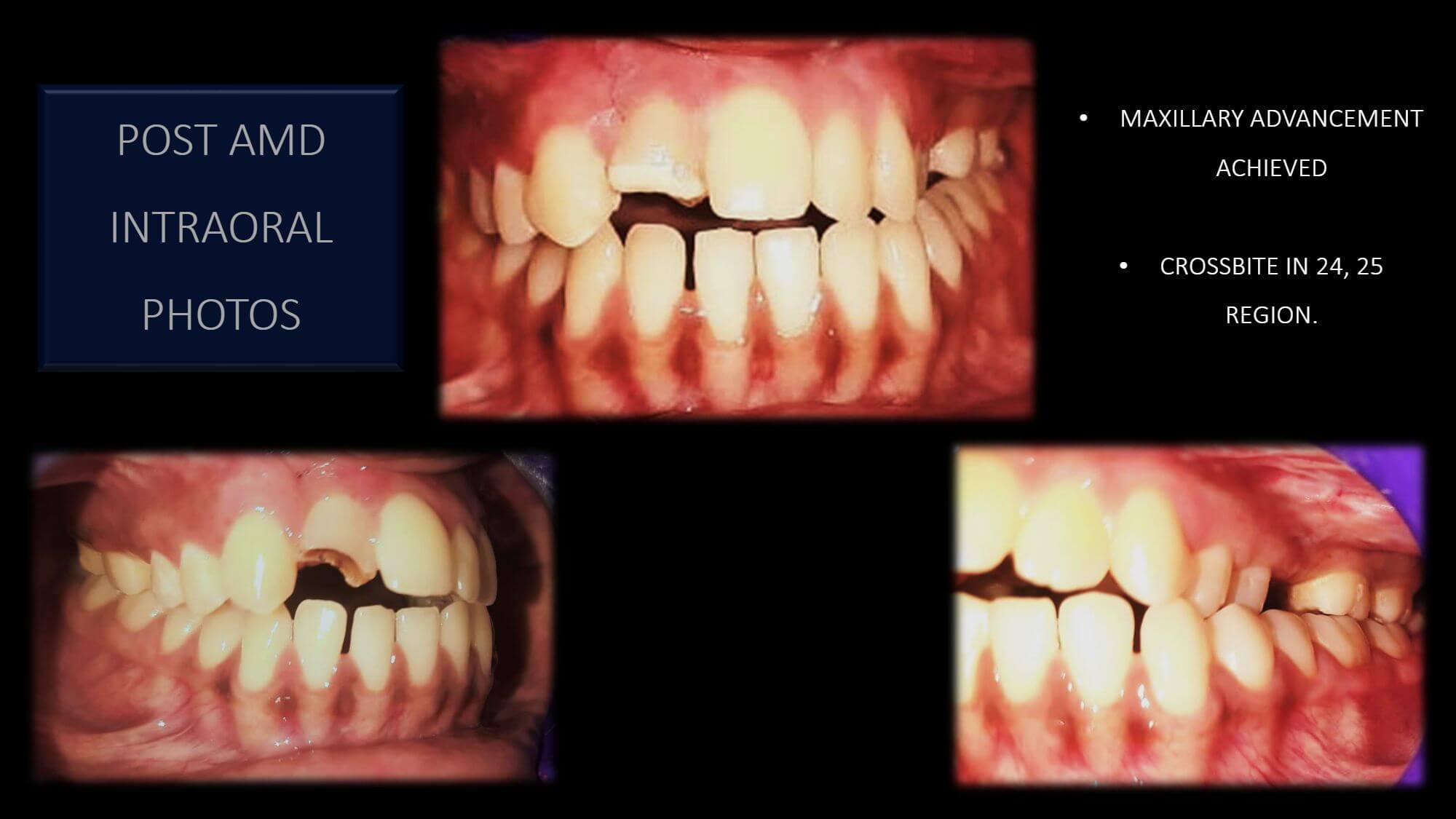 Prosthetic Rehabilitation Post Anterior Maxillary Distraction ...