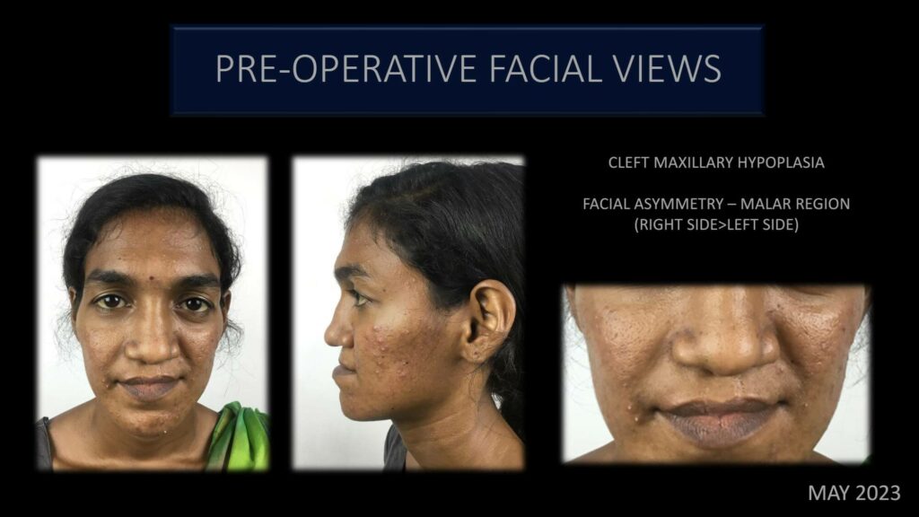 Pre operative facial views