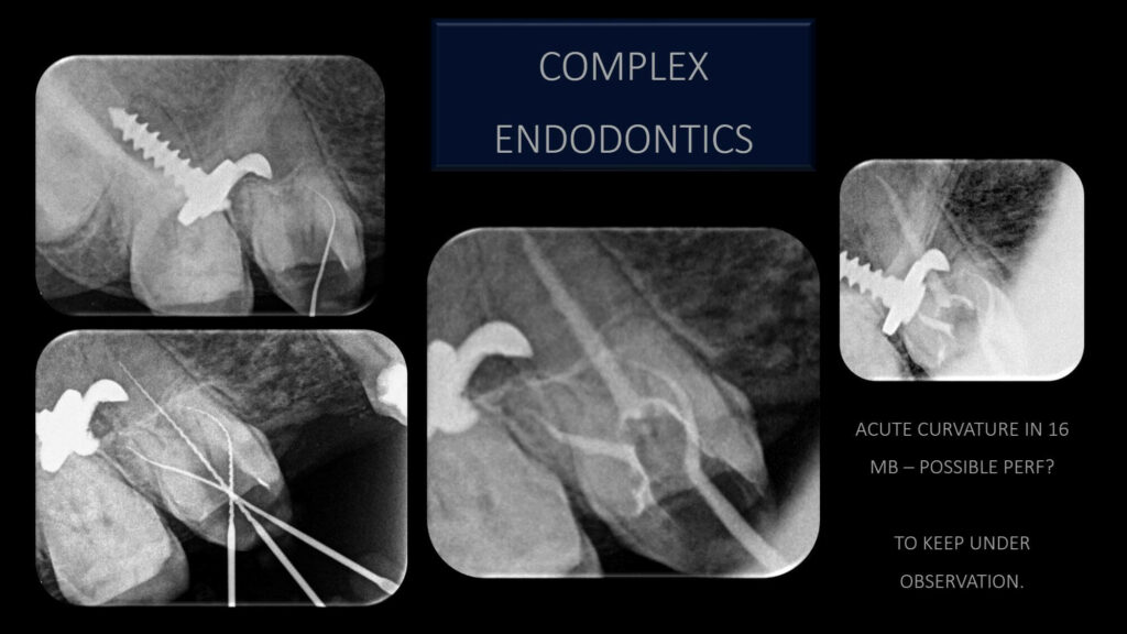 complex endodontics