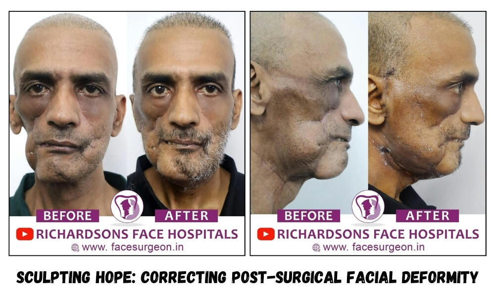 correcting facial deformity