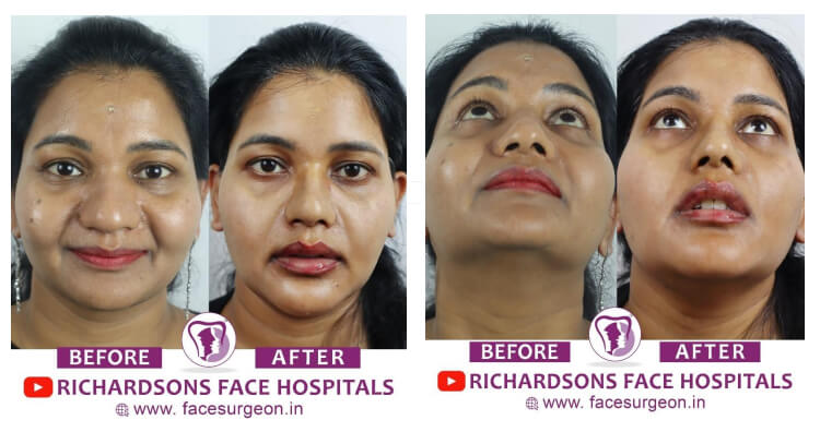 face makeover result