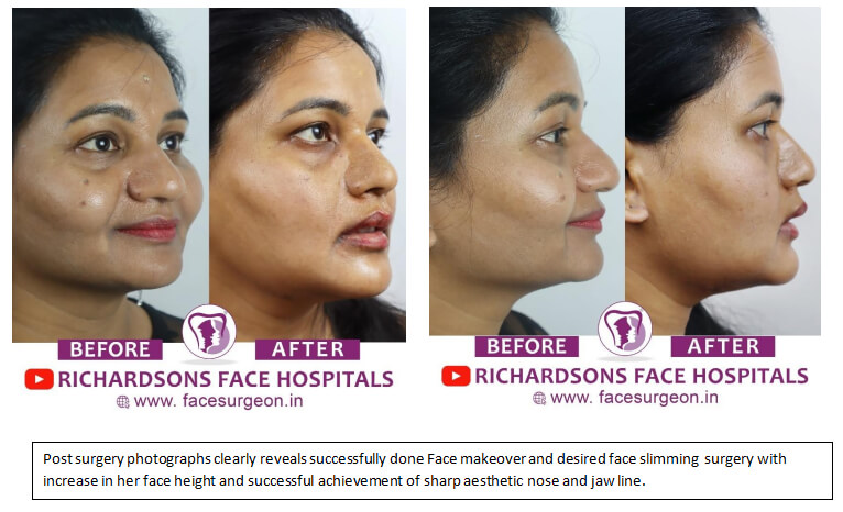 face makeover results