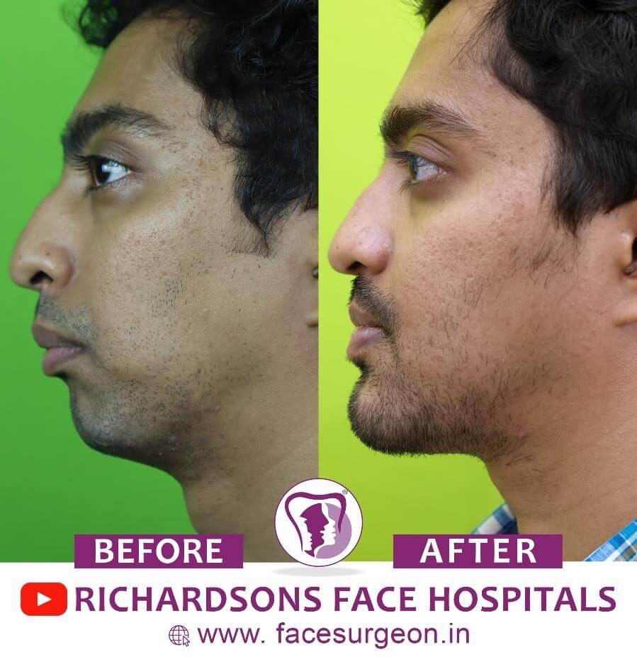 facial plastic jaw surgeries