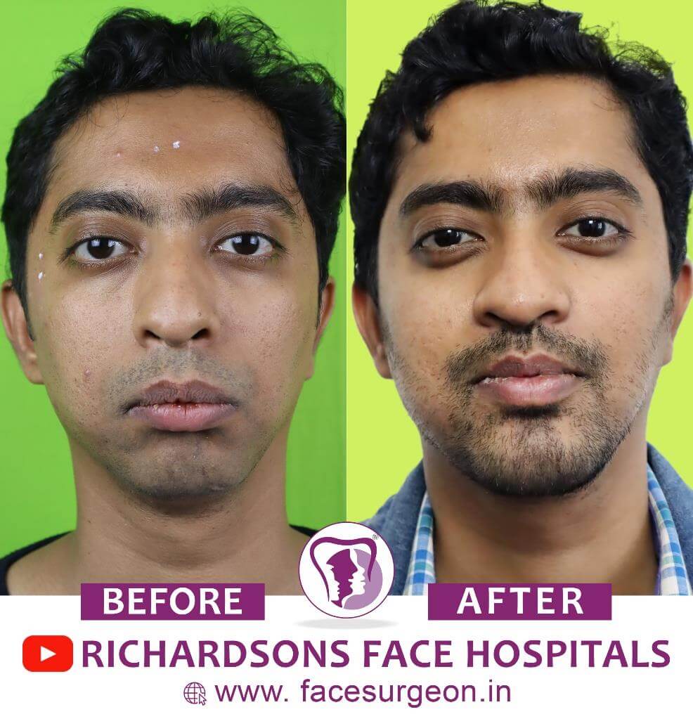 facial transformation