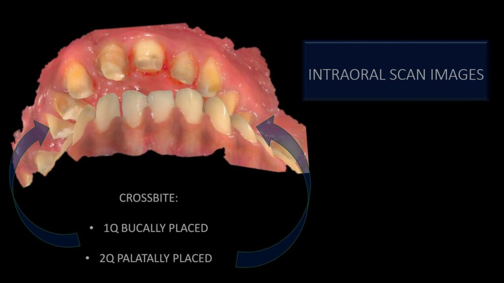 intraoral scan image