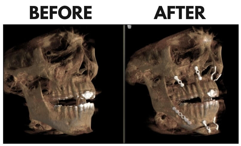 maxillary mandibular advancement