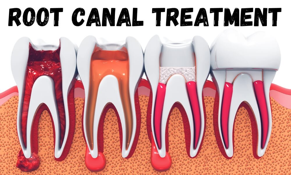 root canal treatments