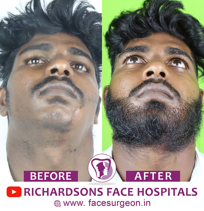 http://Beard%20Transplant%20Men