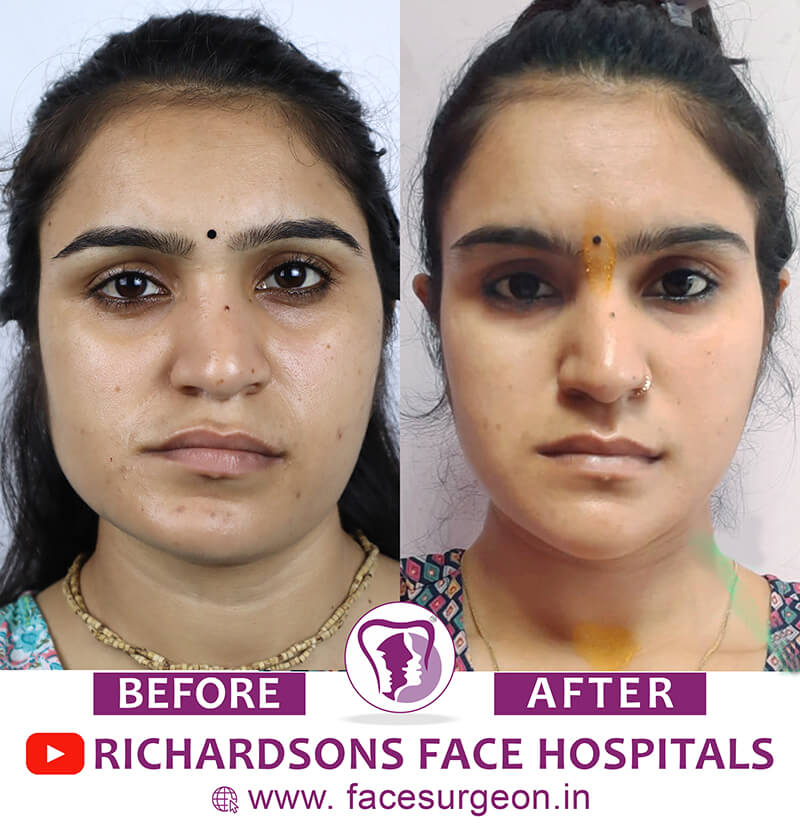 http://Facial%20Asymmetry%20Before%20After