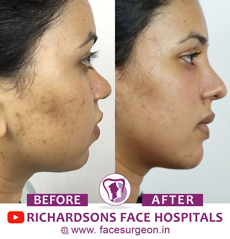 http://Rhinoplasty%20Girl%20Before%20After