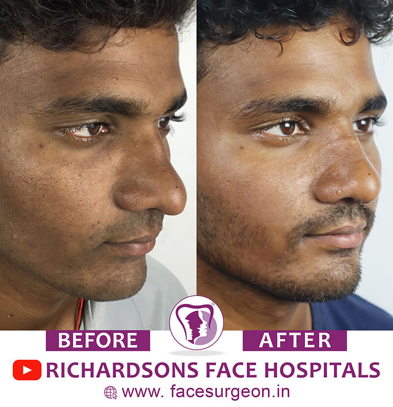 http://Rhinoplasty%20Men%20Before%20After