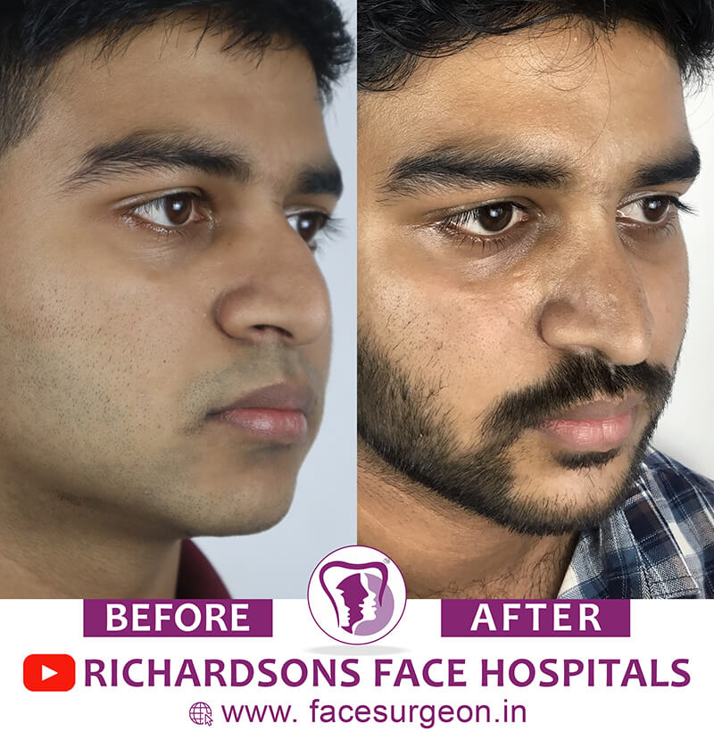http://Rhinoplasty%20Men%20Before%20After%20Image