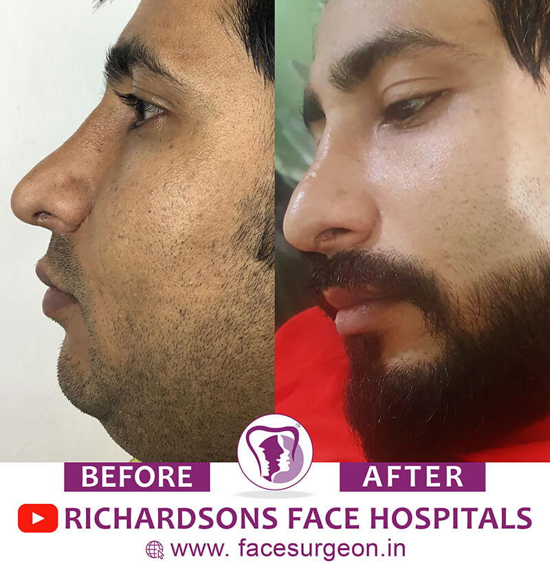 http://Rhinoplasty%20Men%20Before%20&%20After