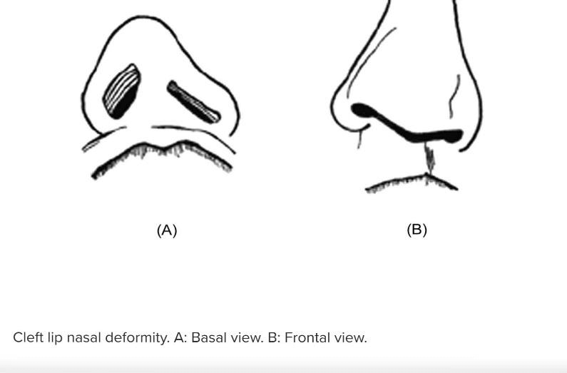 cleft deformities nasal structures