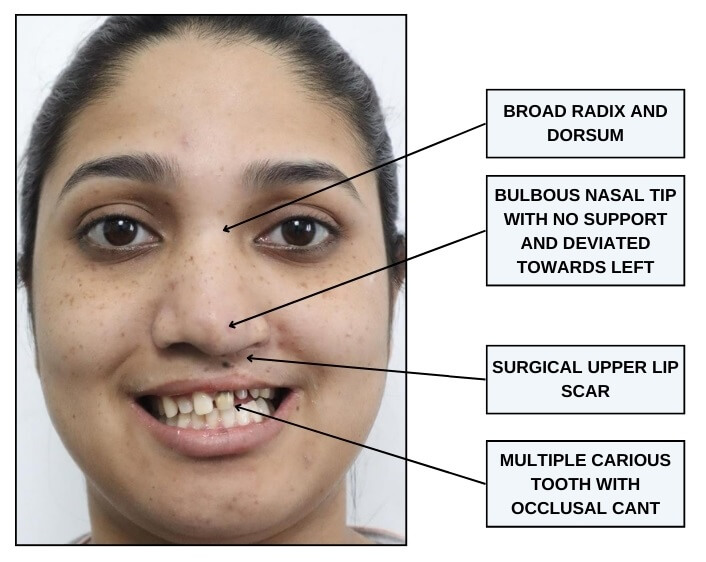 cleft nasal anatomical challenges