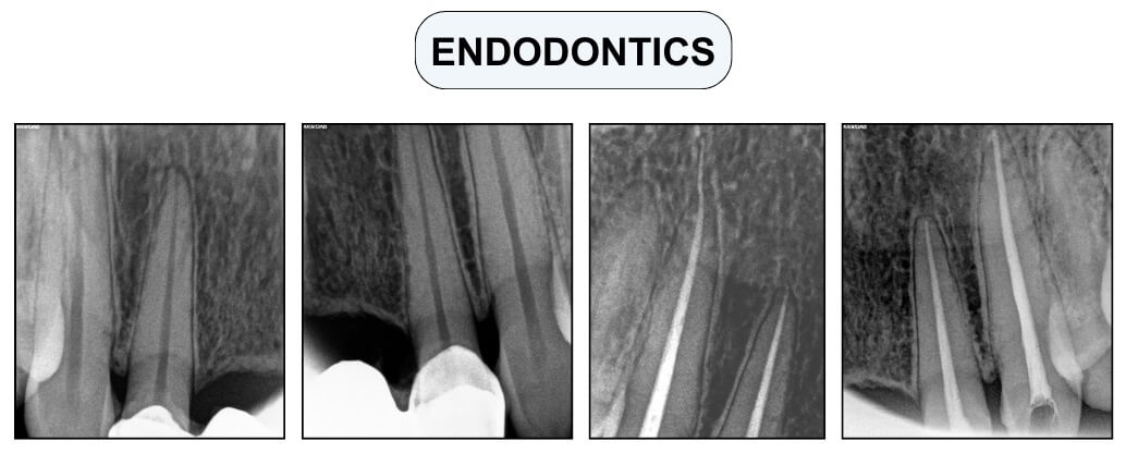 endodontics bridge