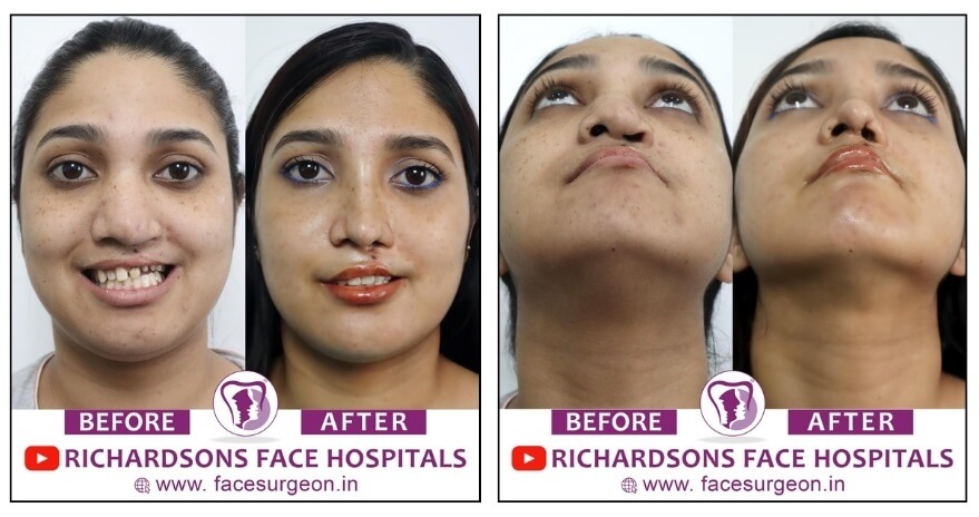lip revision rhinoplasty