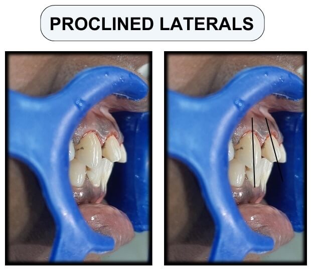 proclined laterals